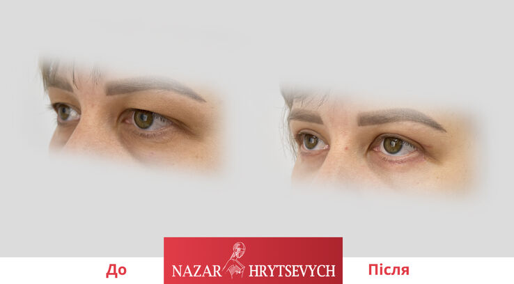 Пластика верхніх і нижніх повік до і після