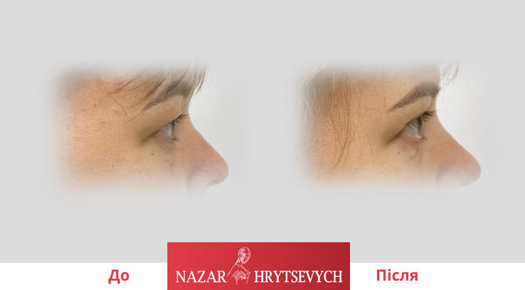 Приклад пластики верхніх і нижніх повік