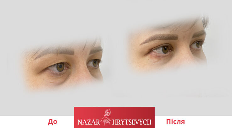 До і після пластики повік