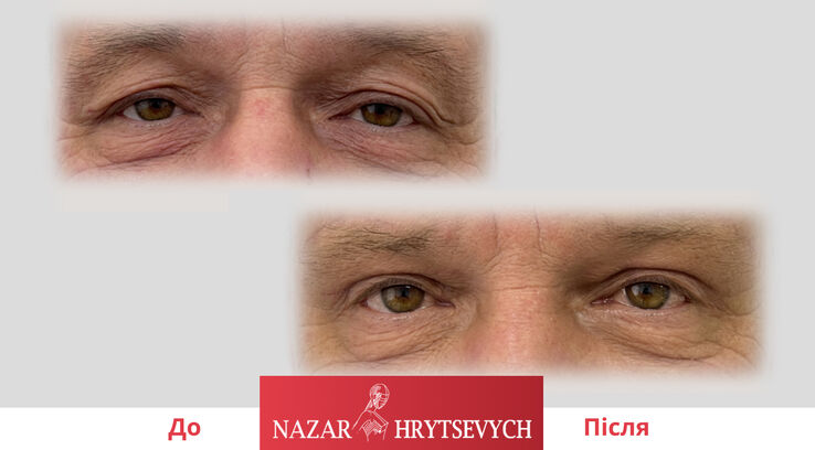 Приклад пластика повік