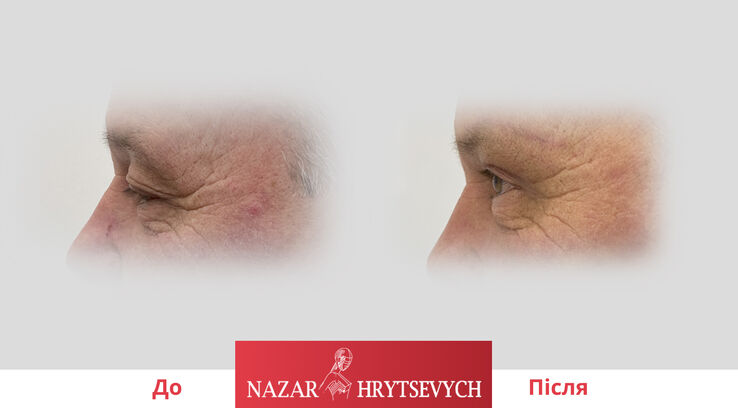 До і після блефаропластики верхніх повік