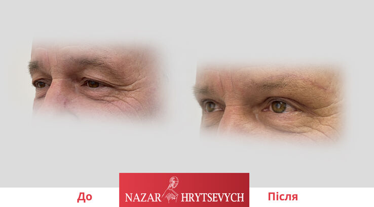 Приклад блефаропластика верхніх повік
