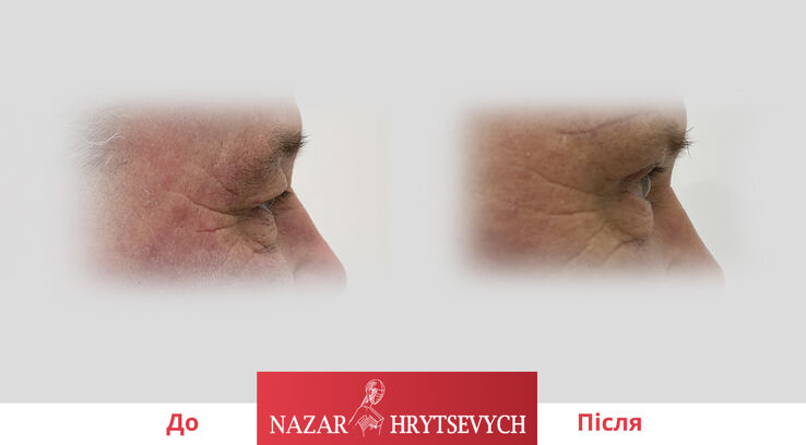 До і після пластики верхніх і нижніх повік