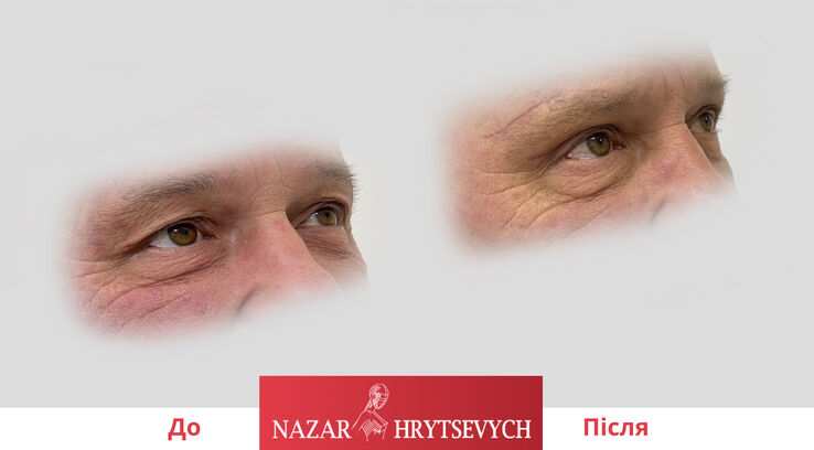 Пластика повік до і після