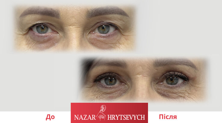Блефаропластика до і після