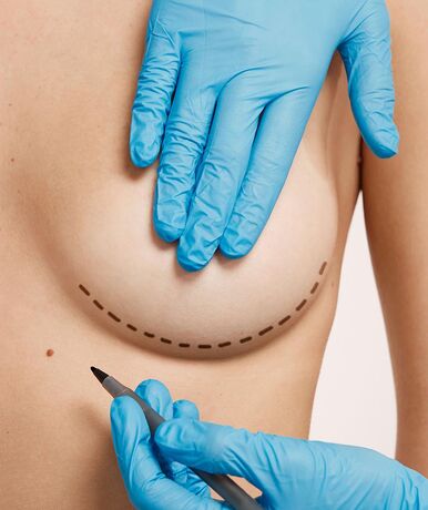 Мастопексия в Хмельницком - Назар Грицевич во Львове